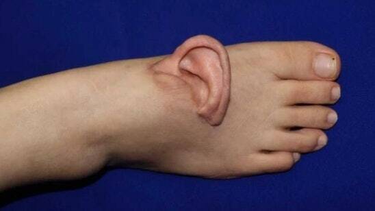 大獎娛樂城、大獎娛樂-線上新聞-駭人聽聞！女工頭皮被機器活活扯下！竟在「腳背上養了5個月耳朵」！奇蹟植回畫面曝光！